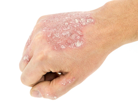 Psoriasis: meer dan alleen symptomen van de huid
