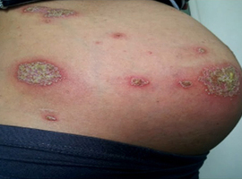 Maladies cutanées chroniques pendant la grossesse et l’allaitement: enjeux thérapeutiques et perspectives