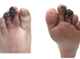Cas clinique: black toes