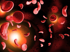Une nouvelle étude sur LentiGlobin dans la drépanocytose