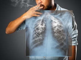 L'UE autorise un traitement de Sanofi dans la bronchite du fumeur