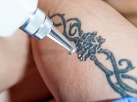 Werklozen laten aan universiteit Rotterdam gratis tatoeages weghalen