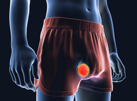 Lymphome testiculaire primitif: des chiffres sur ses caractéristiques cliniques et son pronostic
