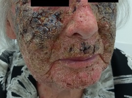 Votre plus belle image: le 5-fluoro-uracile comme traitement de rajeunissement de la peau