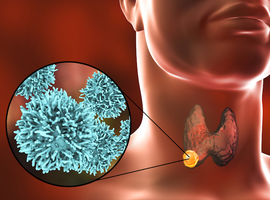 Les cancers thyroïdiens avancés bénéficient-ils également de l’émergence des nouvelles molécules?