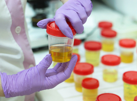 Détection de cellules prostatiques cancéreuses dans l’urine