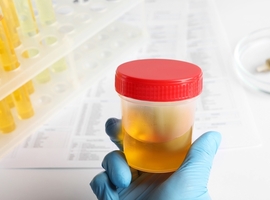 Un nouveau test de méthylation de l’ADN urinaire pour le diagnostic du cancer de la vessie