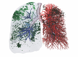 FPI: l’analyse TDM quantitative avec imagerie fonctionnelle est supérieure à la spirométrie «classique»