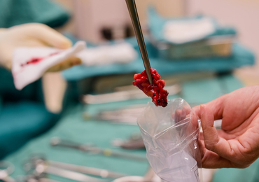 Une biopsie liquide associée à l’IA pour distinguer fibrome et léiomyosarcome avant chirurgie