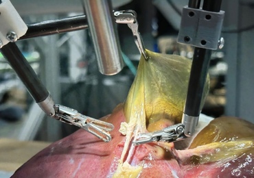 Un robot chirurgical autonome réalise avec succès une opération complexe de la vésicule biliaire