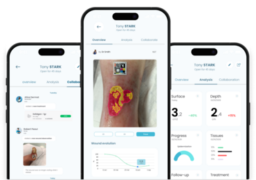 TwinSkin, l'innovation belge qui modélise les plaies en 3D