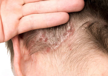 Actualisation du Guide européen (EuroGuiDerm) sur l’eczéma atopique: un résumé