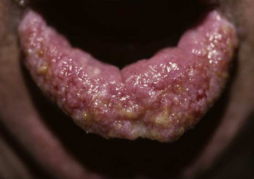 Les manifestations cutanées des maladies inflammatoires du tube digestif