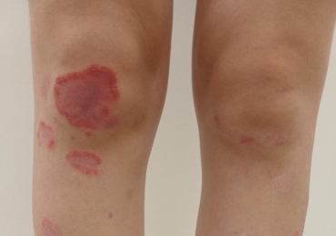 Tinea incognito versus annulaire pustuleuze psoriasis: een diagnostische uitdaging