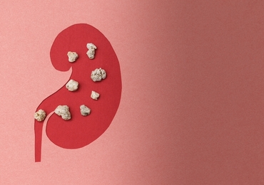 Nierstenen: flexibele ureteroscopie met aspiratie bewijst haar nut ten opzichte van mini-PCNL