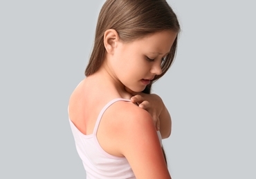 Dermatoses estivales de l’enfant: du coup de soleil aux diagnostics pièges