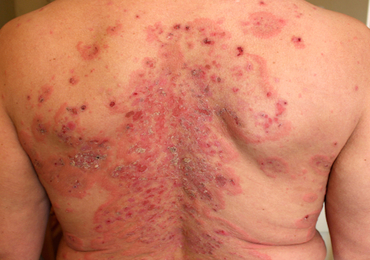 Bevestiging van de werkzaamheid van rituximab als eerstelijnsbehandeling voor pemphigus foliaceus 