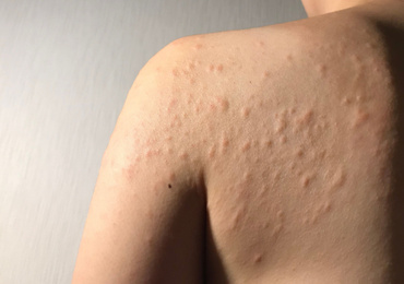 Een klinisch overzicht van contacturticaria
