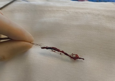 Thrombectomie : cap des 180 procédures franchi en 2025 en région liégeoise