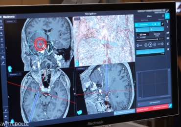 Une opération moins invasive pour traiter l'épilepsie réfractaire aux médicaments