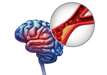 Étude TRIDENT: l’efficacité de trois antihypertenseurs à faible dose dans un comprimé unique après hémorragie intracérébrale