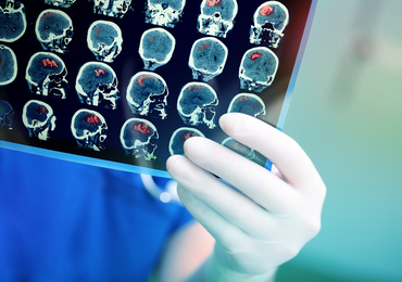Une première étude belge évalue la qualité du parcours de soins des patients atteints d’un gliome