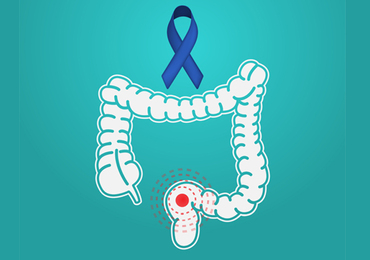 Hausse du cancer colorectal chez les jeunes adultes 