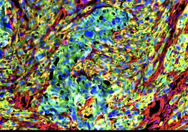 Cancer : l'ULB identifie de nouvelles cibles potentielles contre les métastases
