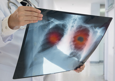 AstraZeneca met fin à un essai clinique sur un médicament contre le cancer du poumon
