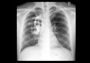 Premiers résultats encourageants pour l'étude ZORALCS sur le cancer du poumon