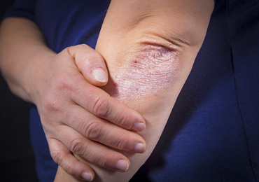 L’efficacité du deucravacitinib à un an dans le rhumatisme psoriasique