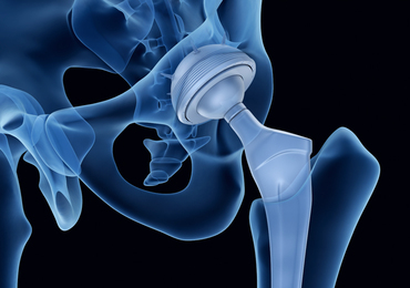 Prothèses de la hanche :   6 recommandations de bonne pratique et 11 points d’amélioration (Audit)