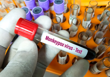 Variole du singe - Roche développe des tests PCR de détection du virus