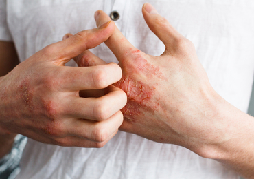 Atopische dermatitis en levenskwaliteit