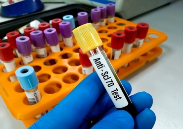 Caractéristiques de la pneumopathie interstitielle précoce et tardive dans la sclérose systémique