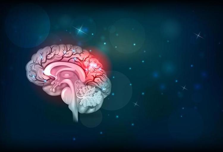 Acute beroerte: hoe herkennen en behandelen?