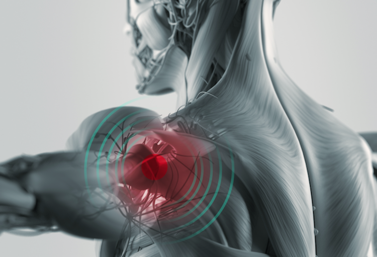 Cadaver course shoulder arthroplasty 2019 The difficult shoulder