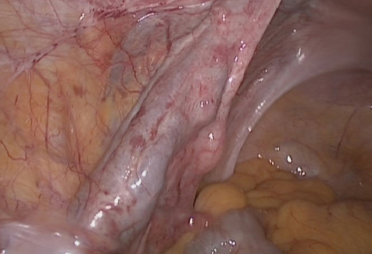 Varice uterine 1 grad