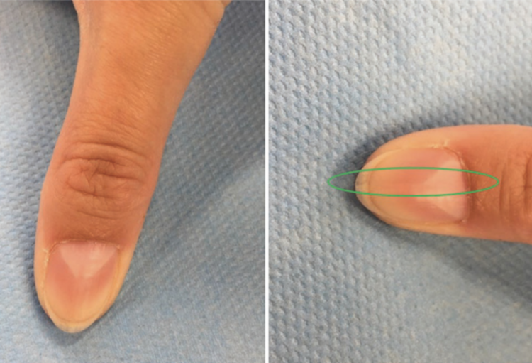 Bungalow opblijven Blauw Dermoscopie van de nagel: opgelet voor de rode streep! - Skin