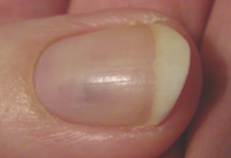 Museum Intuïtie Stewart Island Pijnlijke nagels - De Specialist