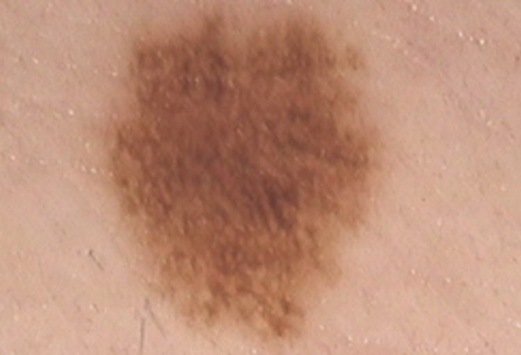 Mélanome in situ - Skin