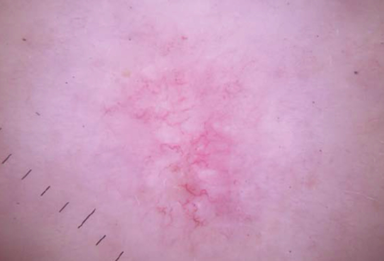 Taches rosées sur les jambes Skin