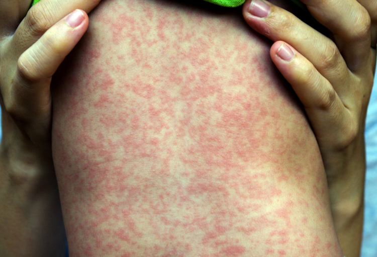 Measles outbreak in southeastern Netherlands, 15 cases reported