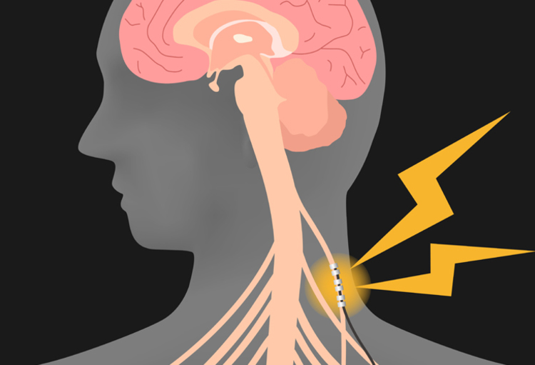 Stimulation du nerf vague dans le traitement de la dépression -  ScienceDirect