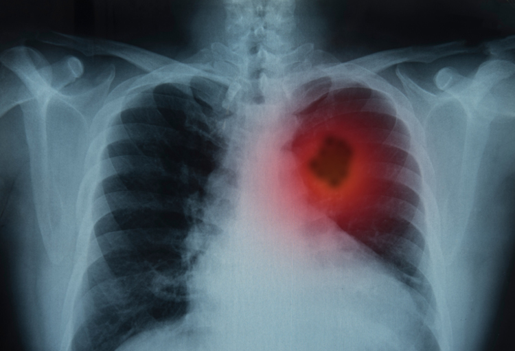 Séminaire : Immunothérapie et cancer du poumon. La révolution en marche.