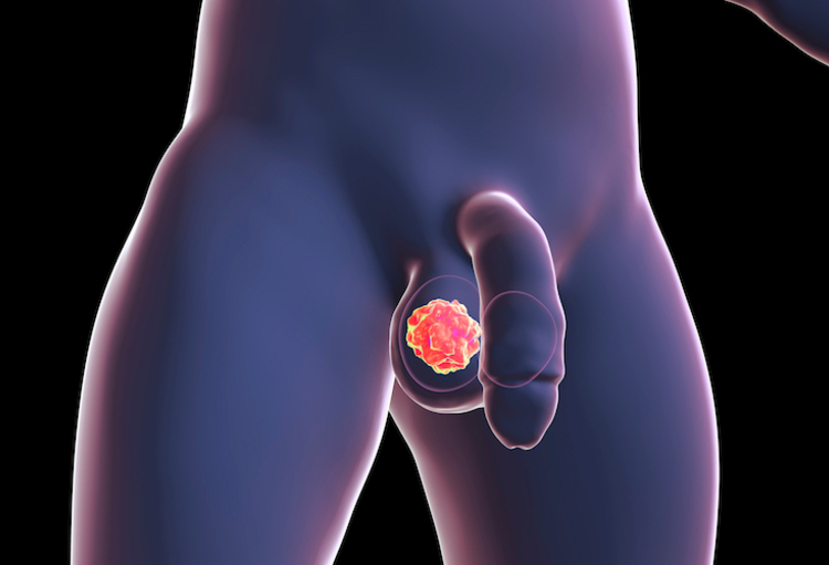 Les cancers du testicule restent rares, mais ils augmentent chez ...