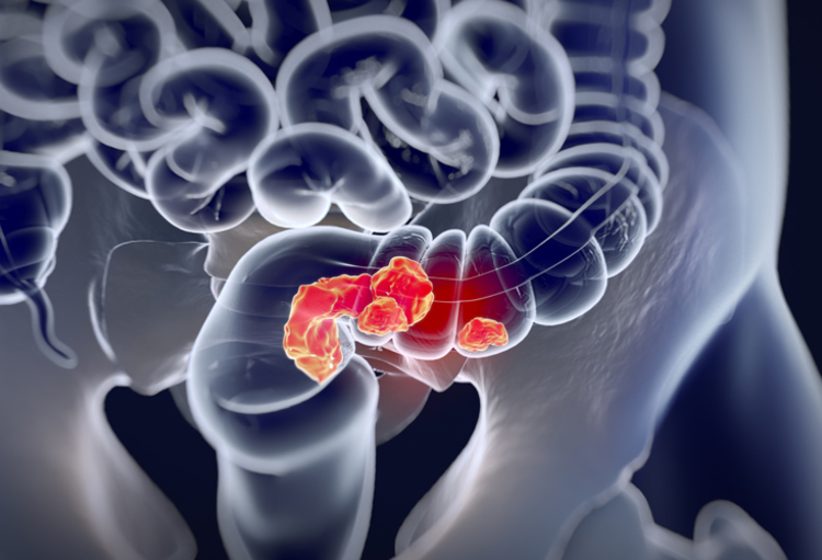Journée de sensibilisation et d'information au dépistage du cancer colo-rectal