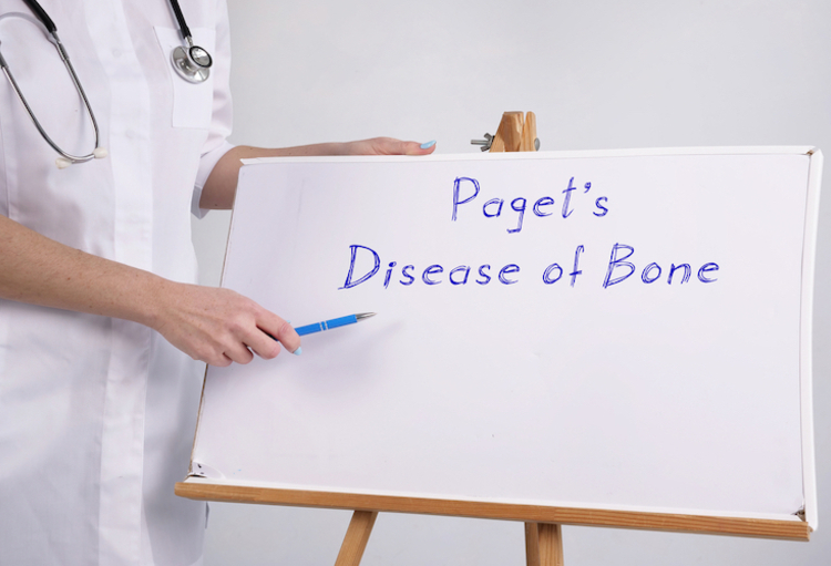 Traitement préventif par zolédronate dans la maladie de Paget dépistée