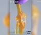 Une articulation du genou fonctionnelle imprimée en 3D 