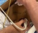 Jonge patiënte via lever aan het hart geopereerd in UZ Saint-Luc